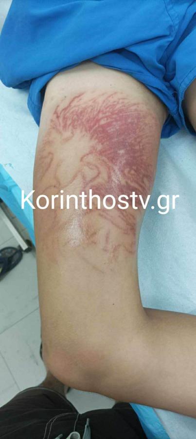 Θαλάσσια ανεμώνη τσίμπημα