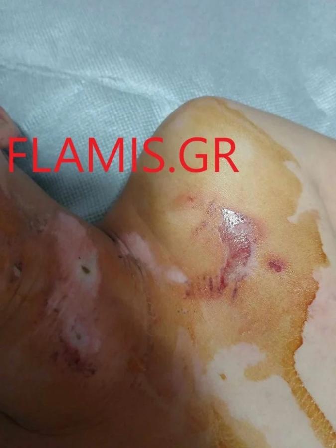 Τραύματα στο σώμα του 9χρονου μαθητή από τα βεγγαλικά