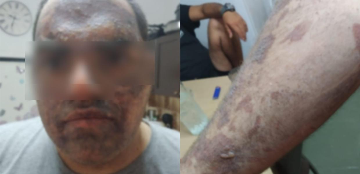 Εργαζόμενος έγκαυμα Κρήτη