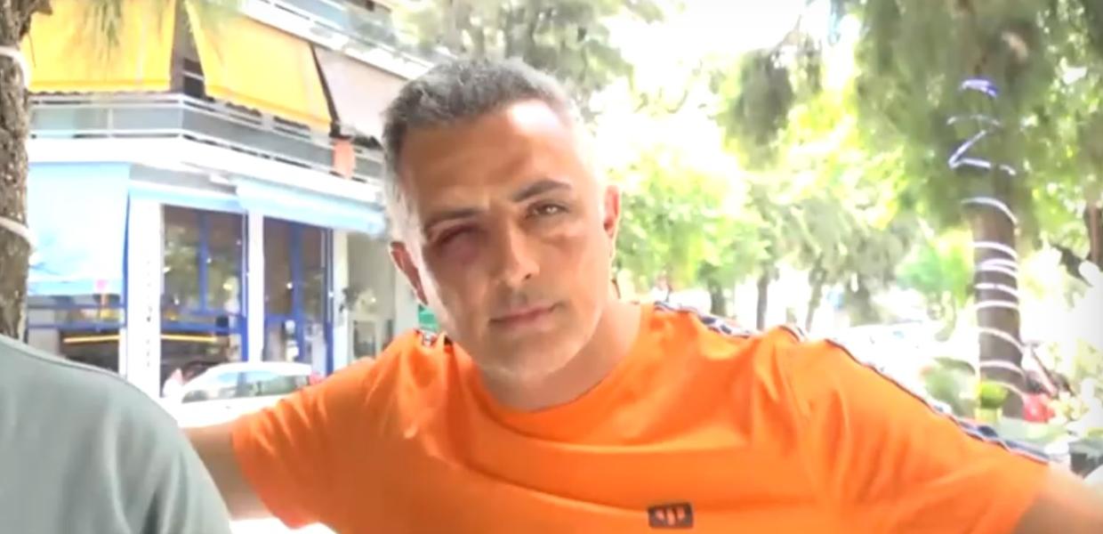 Ο ελεγκτής με μώλωπες στα μάτια μετά τον ξυλοδαρμό του